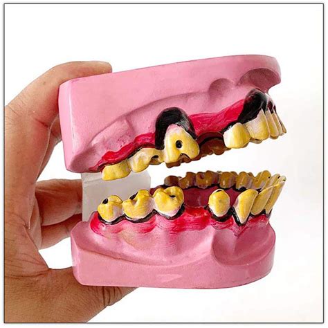 Buy Teeth Model Oral Model Dental 6times Enlarge Dental Tooth Model