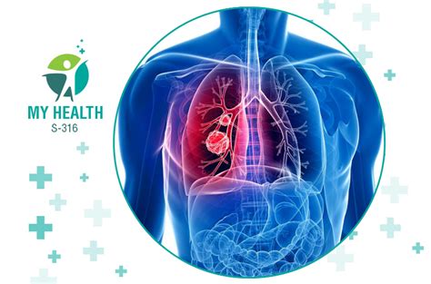 Lung Cancer Types Causes Symptoms Treatment