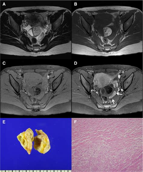 Benign Enhancing Components Of Mature Ovarian Teratoma Magnetic