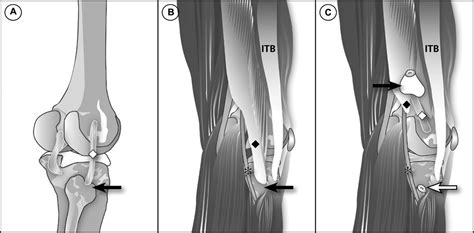 Posterolateral Transfibular Approach To Tibial Plateau Fract