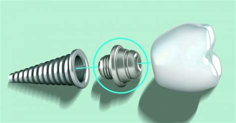 A Guide To Healing Abutments Brighton Implant Clinic Dental Implants