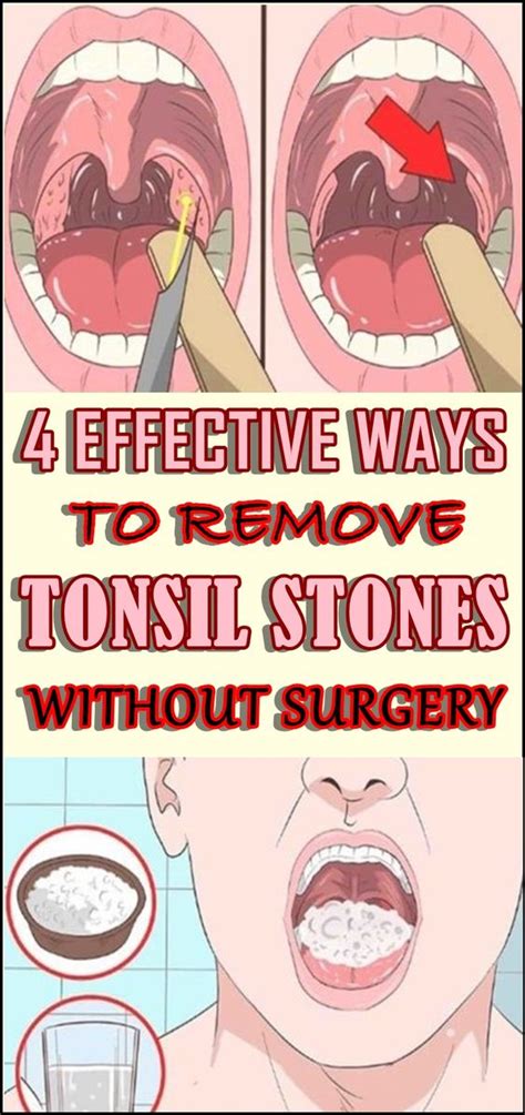 How To Remove Tonsil Stones From Your Throat Howtoermov