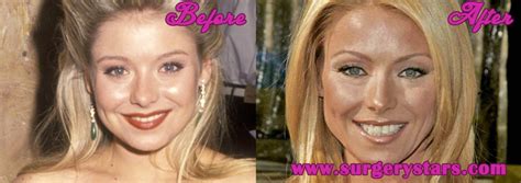 Kelly Ripa Plastic Surgery Before And After Botox Pics