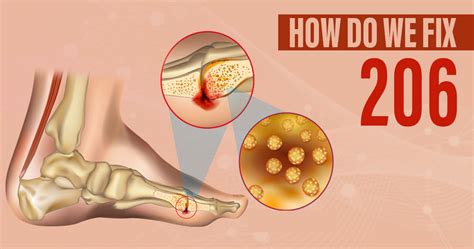 Bone Infection Osteomyelitis Symptoms And Treatment Star Health