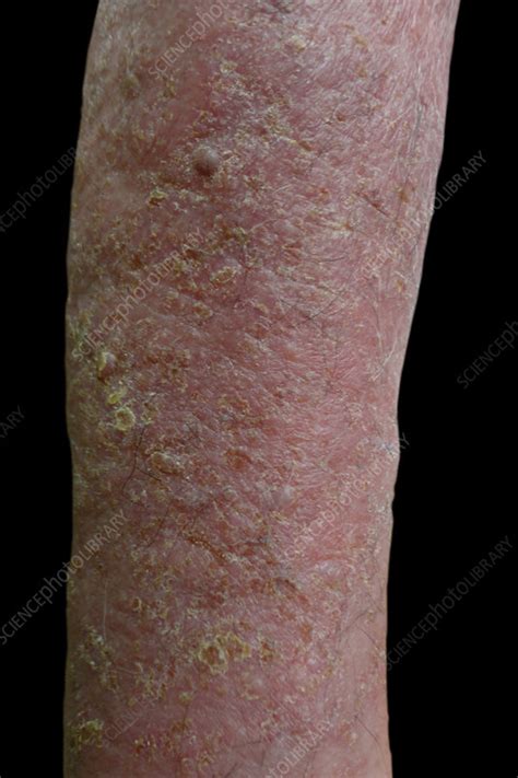 Acute Eczema Stock Image C0402318 Science Photo Library