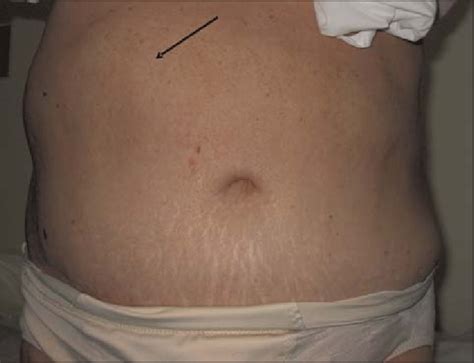 Abdominal Wall Protrusion Following Herpes Zoster At The Right Flank