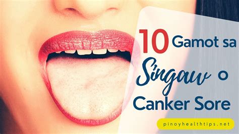 10 Gamot Sa Singaw O Canker Sore Pinoy Health Tips