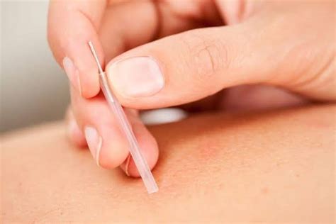 acupuncture vs dry needling uses and benefits