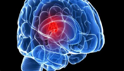 5 Warning Signs Of Brain Tumor That You Should Not Ignore