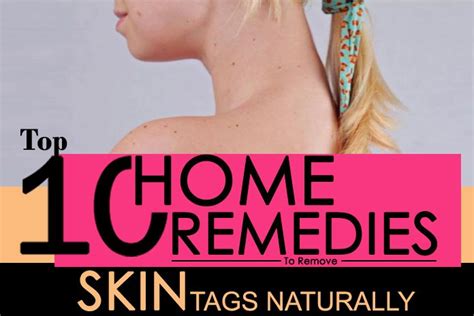 top 10 home remedies to remove skin tags naturally