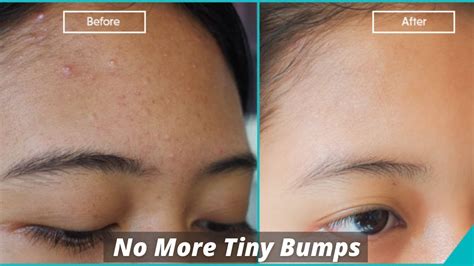 Do This To Get Rid Of Tiny Bumps On Face Glowpink