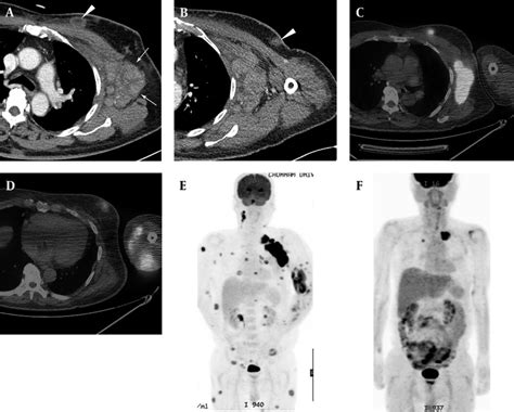 Left Axillary Lymphadenopathies And Cutaneous Involvement In A Case Of