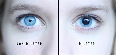 Dilation Retinal Examination Vista Optometry And Keratoconus Center