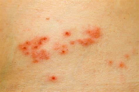 Home Remedies For Shingles Thriftyfun