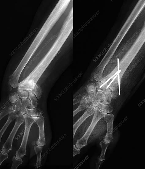 Colles Wrist Fracture X Ray Stock Image M3301648 Science Photo