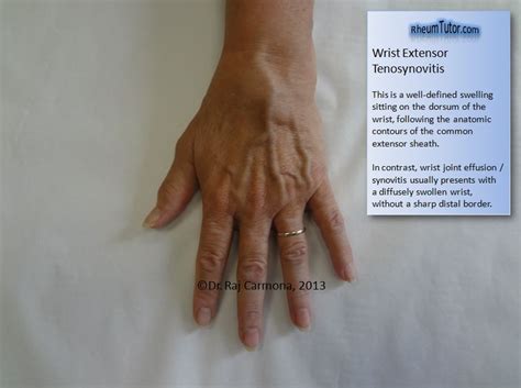 Extensor Tendonitis Wrist