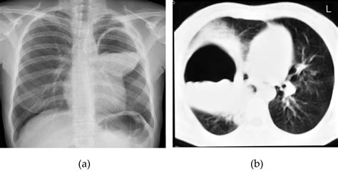 Radiological Characteristics Of Pulmonary Hydatid Cysts Intechopen