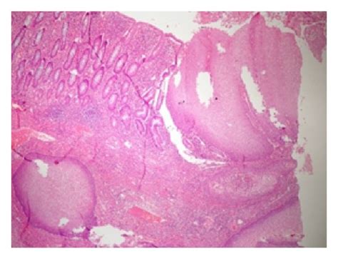 A Duodenal Mucosa And Squamous Cells Are Seen Together Stained With