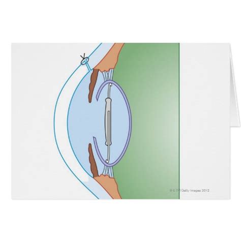 Cataract Surgery Greeting Card Zazzle