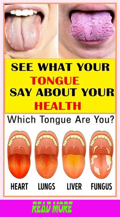 What Does Your Tongue Say About Your Health In 2024 Daily Health Tips Health Good Health Tips