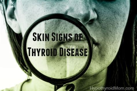Thyroid cancers represent approximately 1% of new cancer diagnoses in the united states each year. Skin signs of thyroid disease | low-normal thyroid ...