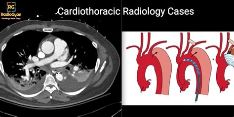 Cardiothoracic Radiology Webinars Str Radiogyan