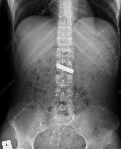 Swallowed Battery X Ray Stock Image C0070594 Science Photo Library