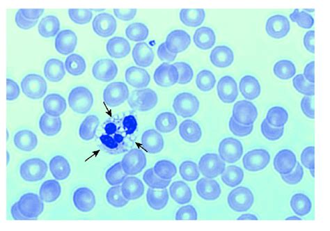 Figure Peripheral Blood Smear Showing Lipid Vacuoles Arrows In