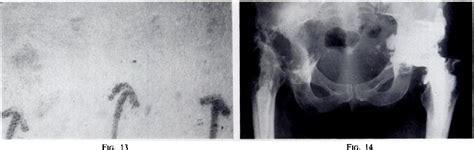 Figure 13 From Cobalt Toxicity After Mckee Hip Arthroplasty Semantic