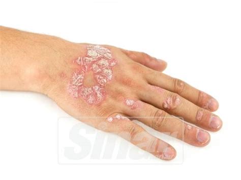 Penyebab dan cara mencegah psoriasispsoriasis merupakan gangguan kulit yang disebabkan oleh masalah autoimun. Kim Kardashian West pun kena psoriasis