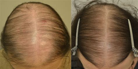 Finasteride Females Before And After Photos Hair Restoration Of The