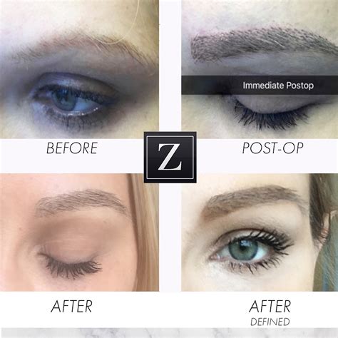 Natural Beauty Of Eyebrow Transplant Surgery Ziering Medical