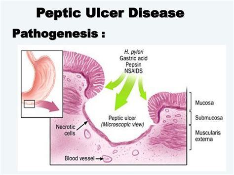 Ppt Peptic Ulcer Disease Powerpoint Presentation Free Download Id