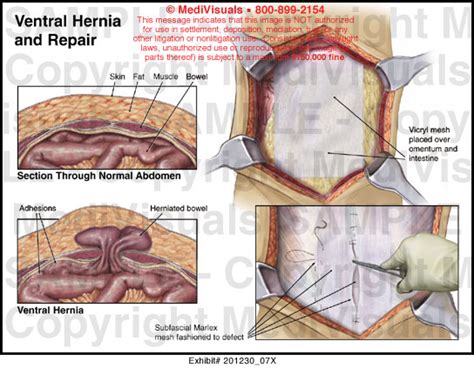 Ventral Hernia And Repair Medical Exhibit Medivisuals