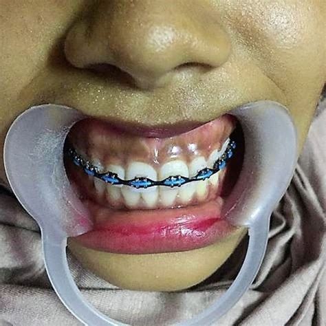 Pin By John Beeson On Orthodontic Braces In 2021 Orthodontics Braces