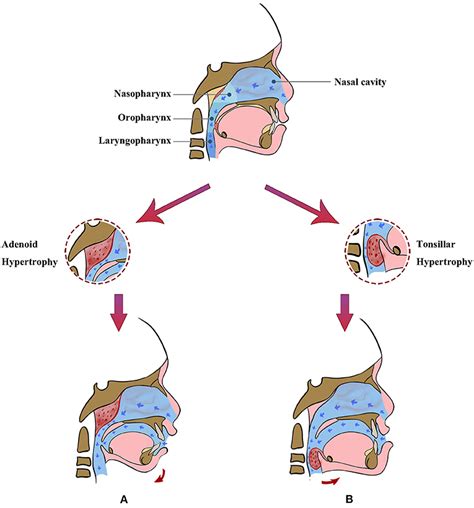 Frontiers The Impact Of Mouth Breathing On Dentofacial Development A Concise Review