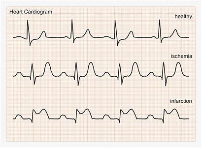 Heart Ecg Cardiogram Rhythm Healthy Types Waves