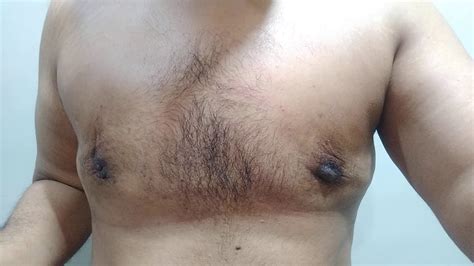Gynecomastia Surgery Treatment Recovery Post Up 4 5 Month YouTube