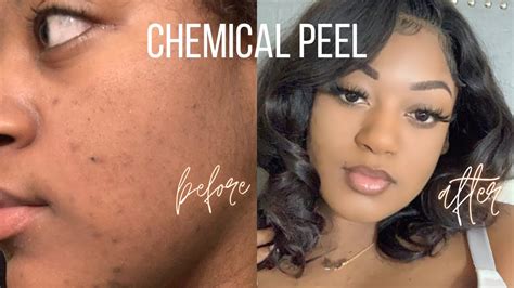 First Chemical Peel Brightening Dark Spots And Hyperpigmentation Youtube