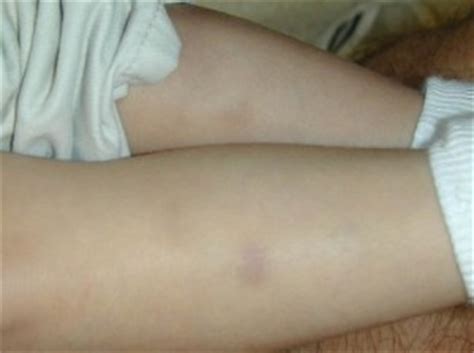 Venous blood clots occur most commonly in the arms and legs. Blood Clot Symptoms