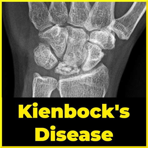 Review Of Kienbӧck Disease Sports Medicine Review