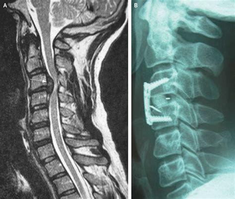 Post Traumatic Herniated Cervical Disk — Nejm