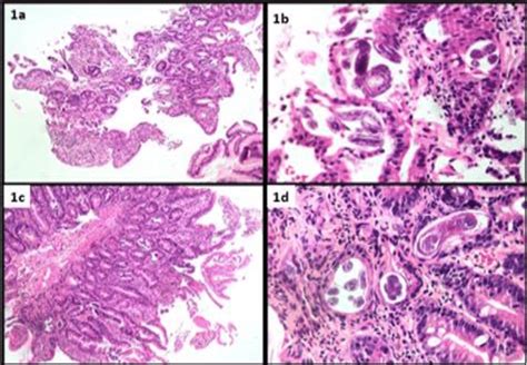A And B Gastric Mucosal Biopsy With Active Inflammation And