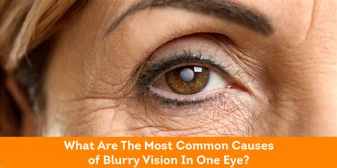 What Are The Most Common Causes Of Blurry Vision In One Eye Pristyn Care