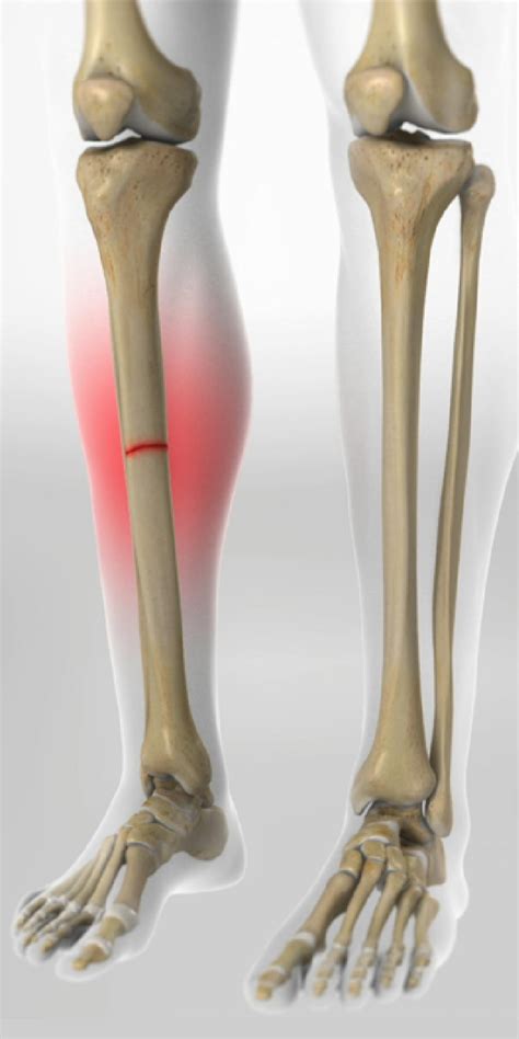 Tibial Fractures Orthoriverside Com