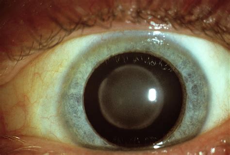Cataract In Eye Photograph By Sue Fordscience Photo Library