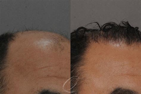 Fut Before After Photos Patient Serving Rochester Syracuse