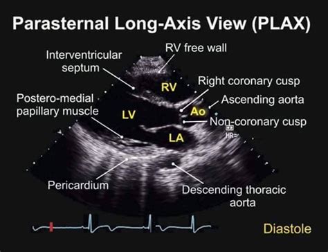 Parasternal Long Axis View Tee Diagnostic Medical Sonography Echocardiogram Medical Ultrasound