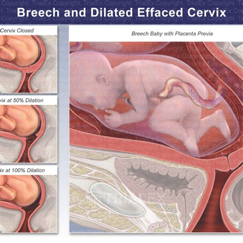 Breech And Dilated Effaced Cervix Trial Exhibits Inc