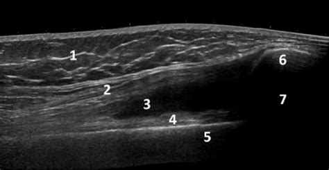 Ultrasound For Knee Effusion Lipohaemarthrosis And Tibial Plateau
